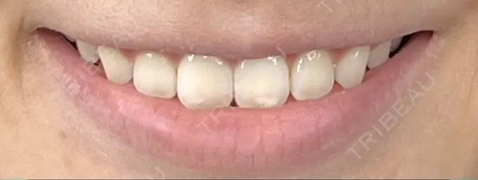 ホワイトニング SK新宿歌舞伎町美容外科・歯科 DAY 90 メイン用