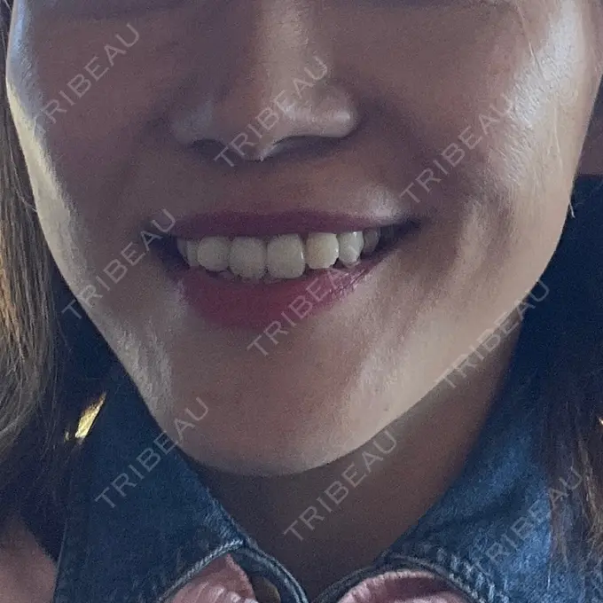 ボトックス（エラ・小顔） TCB東京中央美容外科 銀座二丁目院 DAY 54 メイン用