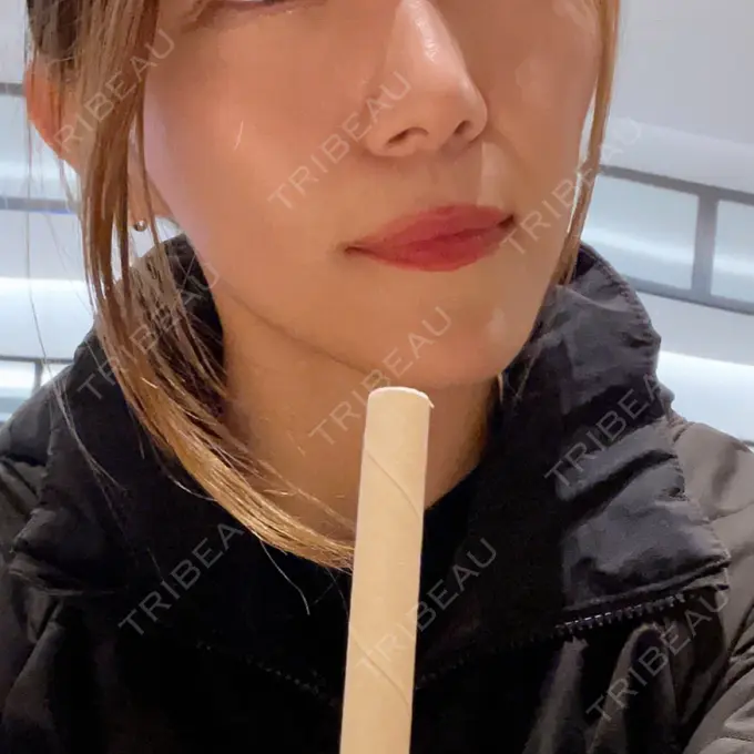 ボトックス（エラ・小顔） TCB東京中央美容外科 銀座二丁目院 DAY 23 メイン用