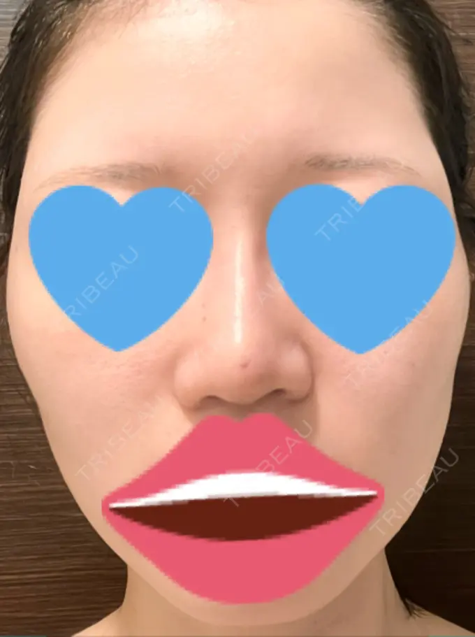 隆鼻術 / ボトックス（エラ・小顔） TCB東京中央美容外科 福岡博多院 AFTER メイン用