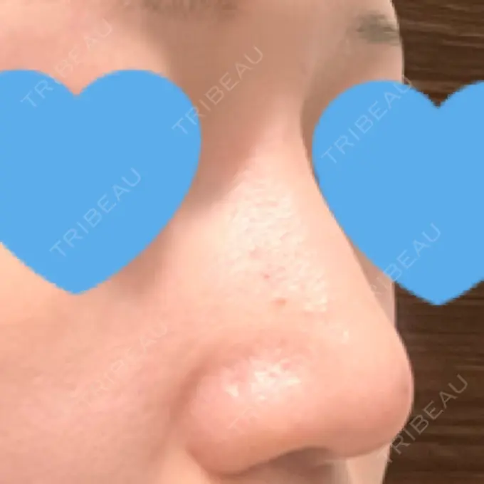 隆鼻術 / ボトックス（エラ・小顔） TCB東京中央美容外科 福岡博多院 DAY 15 メイン用