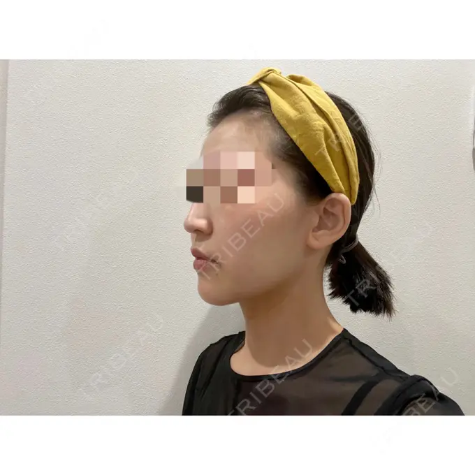 糸リフト / 脂肪吸引（顔） / ジョールファット除去 / ボトックス（エラ・小顔） WOM CLINIC GINZA （ワム クリニック ギンザ） DAY 61 メイン用