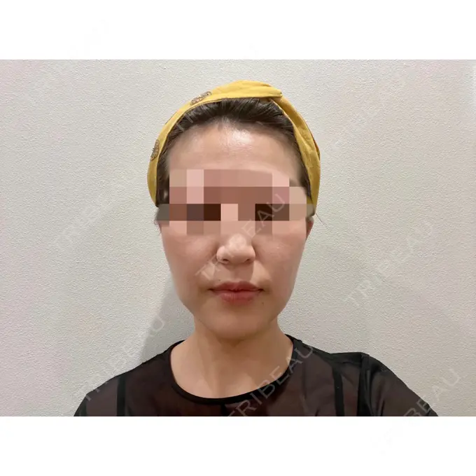 糸リフト / 脂肪吸引（顔） / ジョールファット除去 / ボトックス（エラ・小顔） WOM CLINIC GINZA （ワム クリニック ギンザ） DAY 61 メイン用