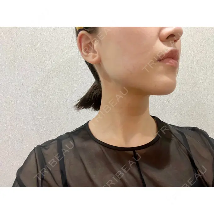 糸リフト / 脂肪吸引（顔） / ジョールファット除去 / ボトックス（エラ・小顔） WOM CLINIC GINZA （ワム クリニック ギンザ） DAY 61 メイン用