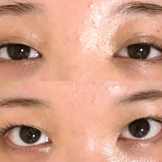 目頭切開 くさのたろうクリニック DAY 421 メイン用