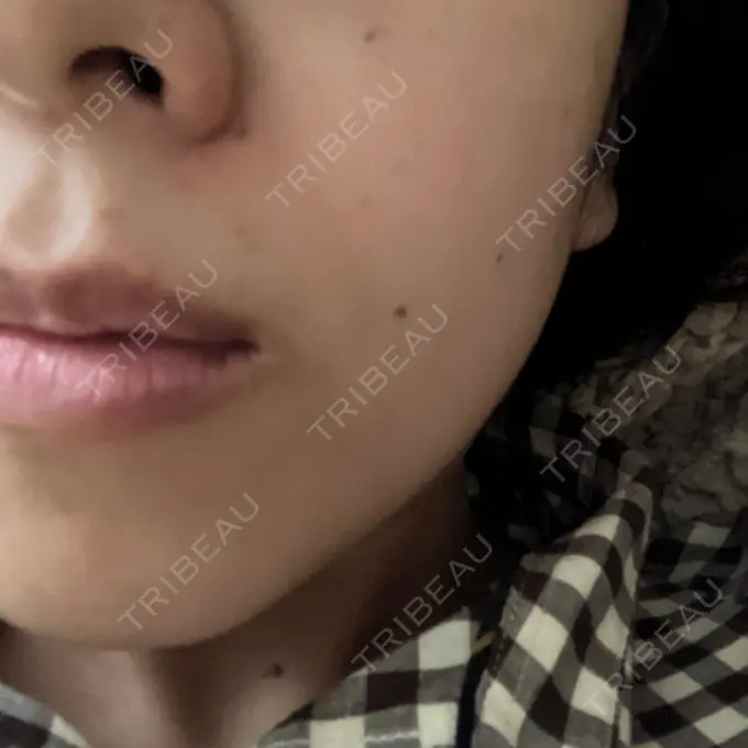 ピーリング（ハリ・ツヤ） 大塚美容形成外科・歯科 大塚本院 DAY 3 メイン用