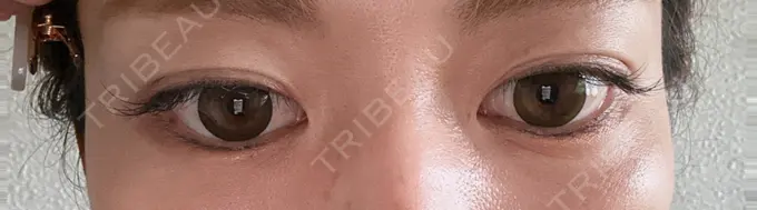 ボトックス（目尻） TCB東京中央美容外科 青森院 AFTER メイン用