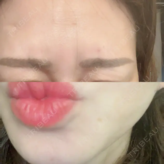 ボトックス（あご） / ボトックス（タレ目） / ボトックス（眉間） / ボトックス（目尻） DMTC CLINIC 日本橋院 AFTER メイン用