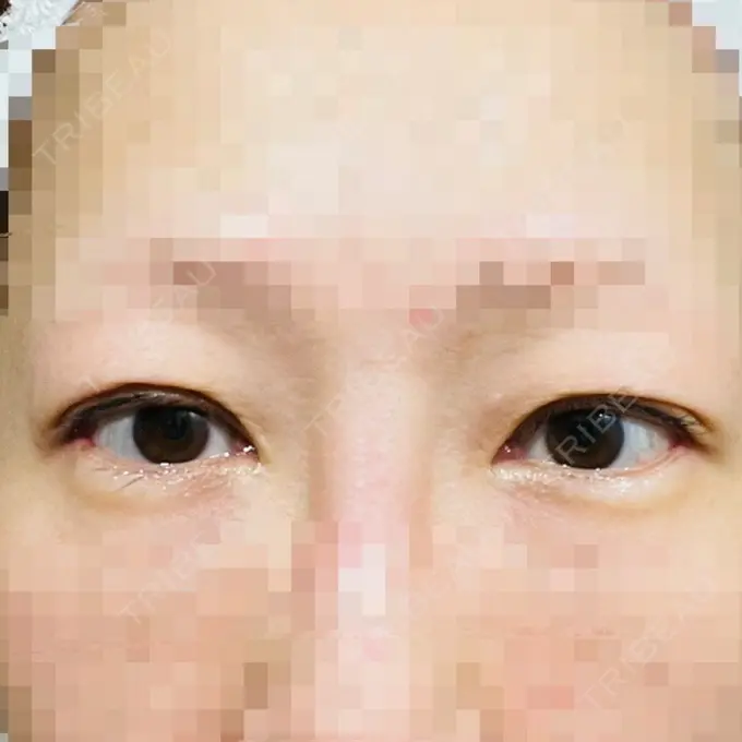 目尻切開 / タレ目形成・グラマラスライン（埋没） LOUIS CLINIC 二子玉川院【ルイクリニック】 AFTER メイン用