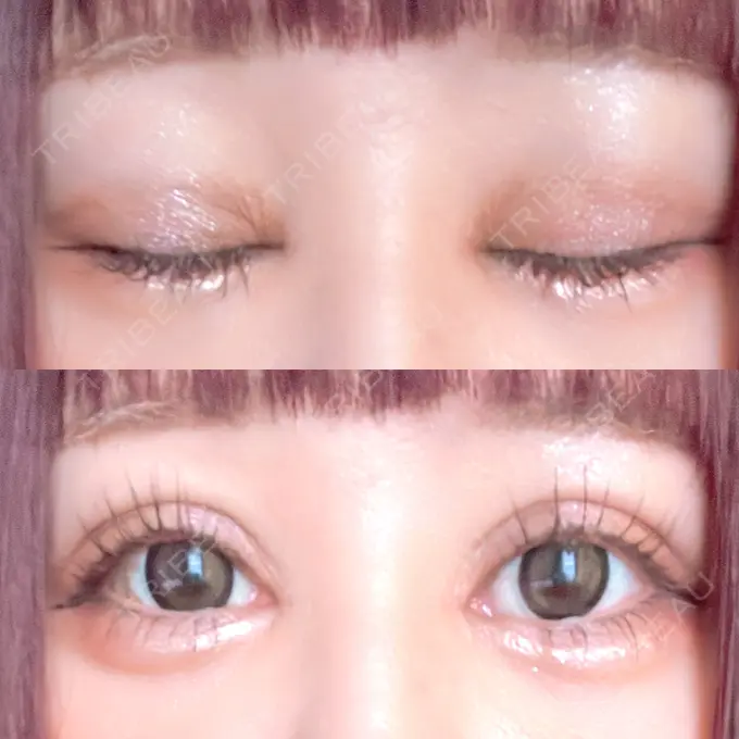 二重埋没 / 目頭切開 Brandnew Beauty Clinic AFTER メイン用