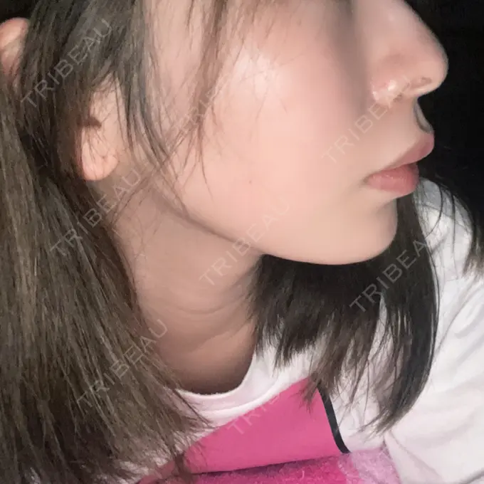 ヒアルロン酸注入（あご） / ボトックス（エラ・小顔） フィラークリニック 名古屋栄院 DAY 0 メイン用