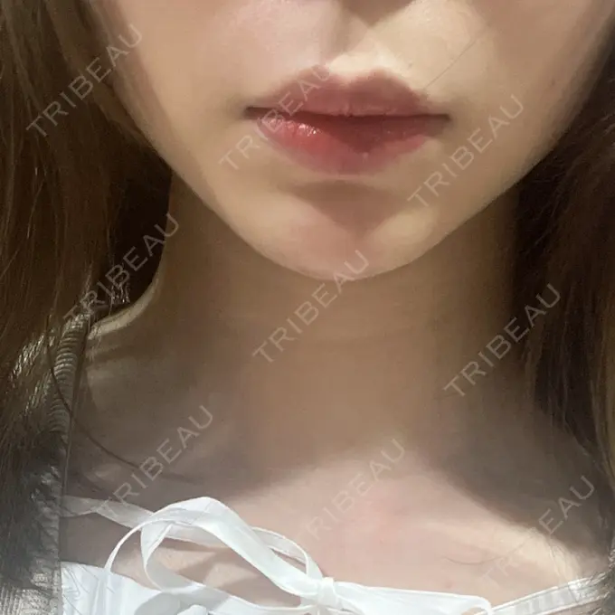 ヒアルロン酸注入（あご） / ボトックス（エラ・小顔） フィラークリニック 名古屋栄院 AFTER メイン用