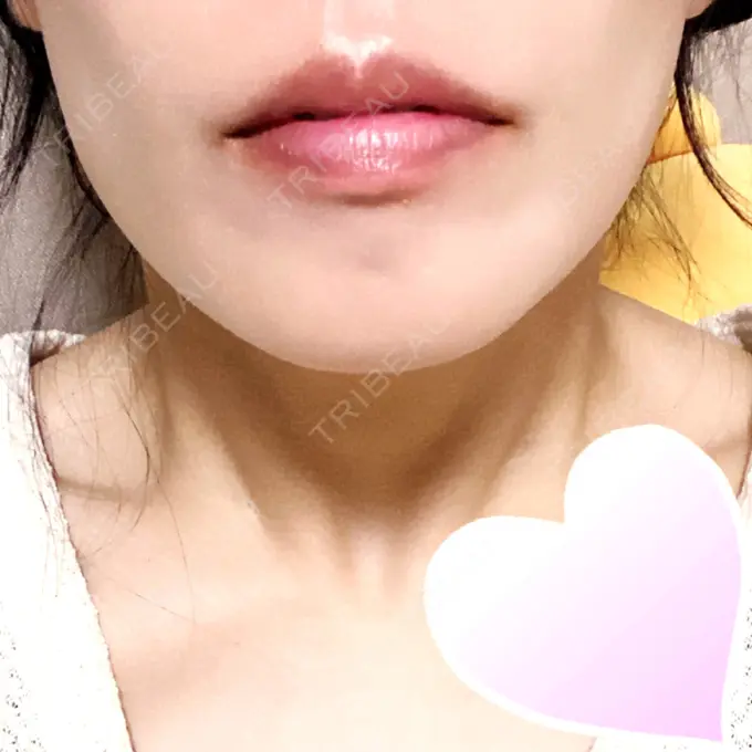 ボトックス（エラ・小顔） TCB東京中央美容外科 心斎橋院 AFTER メイン用