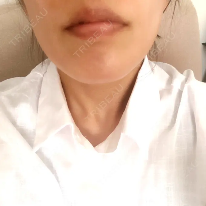 ボトックス（エラ・小顔） TCB東京中央美容外科 心斎橋院 DAY 4 メイン用