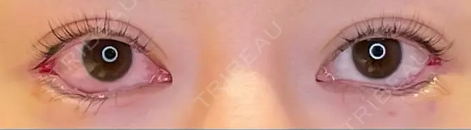 目尻切開 / タレ目形成・グラマラスライン（埋没） / 美容点滴・美容注射（美肌） LOUIS CLINIC 二子玉川院【ルイクリニック】 DAY 0 メイン用