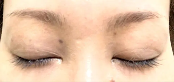 ピコレーザートーニング（美白・肝斑） / ピコスポット 日比谷セントラルクリニック DAY 10 メイン用