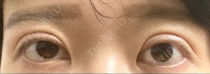 二重切開 / 目元修正 心斎橋コムロ美容外科クリニック DAY 319 メイン用