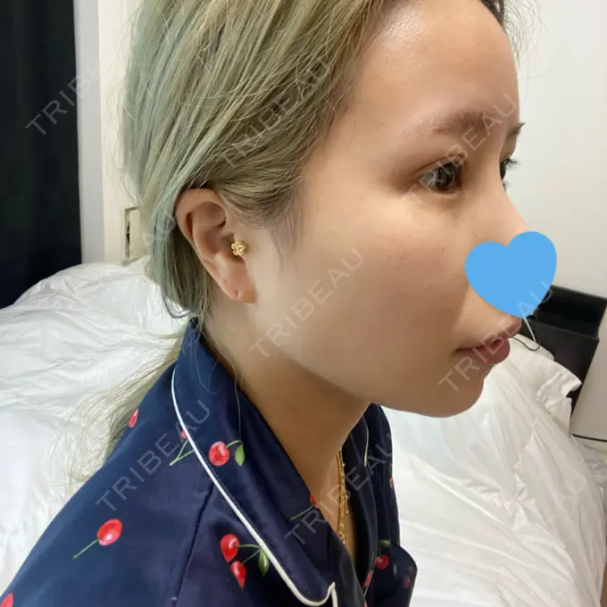 脂肪吸引（顔） Casa de GRACIA GINZA 【カーサデグラシアギンザ】 DAY 91 メイン用