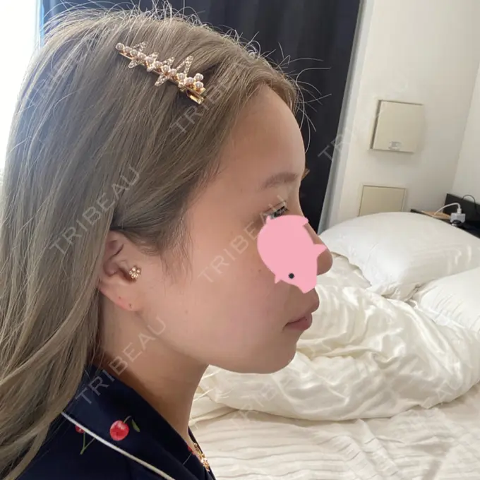 脂肪吸引（顔） Casa de GRACIA GINZA 【カーサデグラシアギンザ】 DAY 49 メイン用