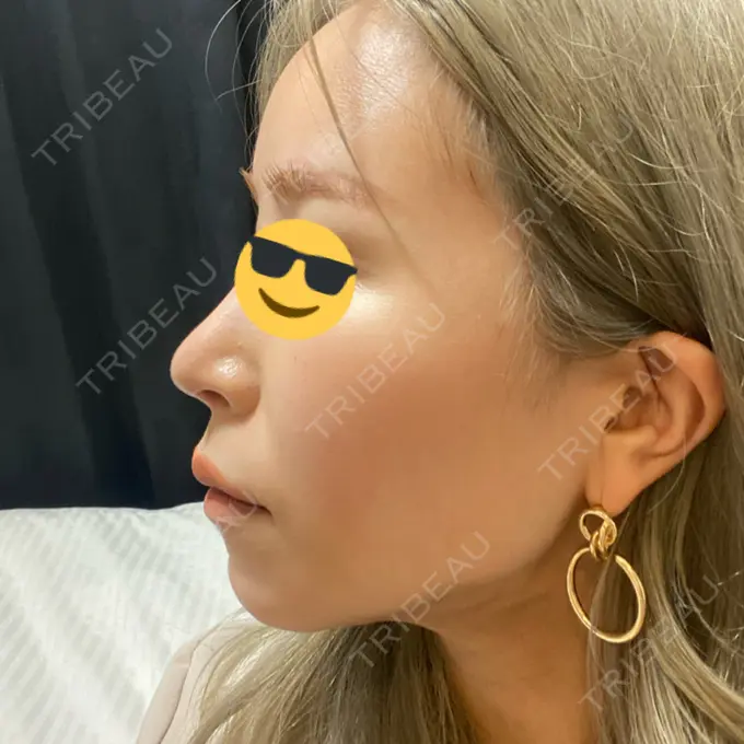 脂肪吸引（顔） Casa de GRACIA GINZA 【カーサデグラシアギンザ】 DAY 49 メイン用