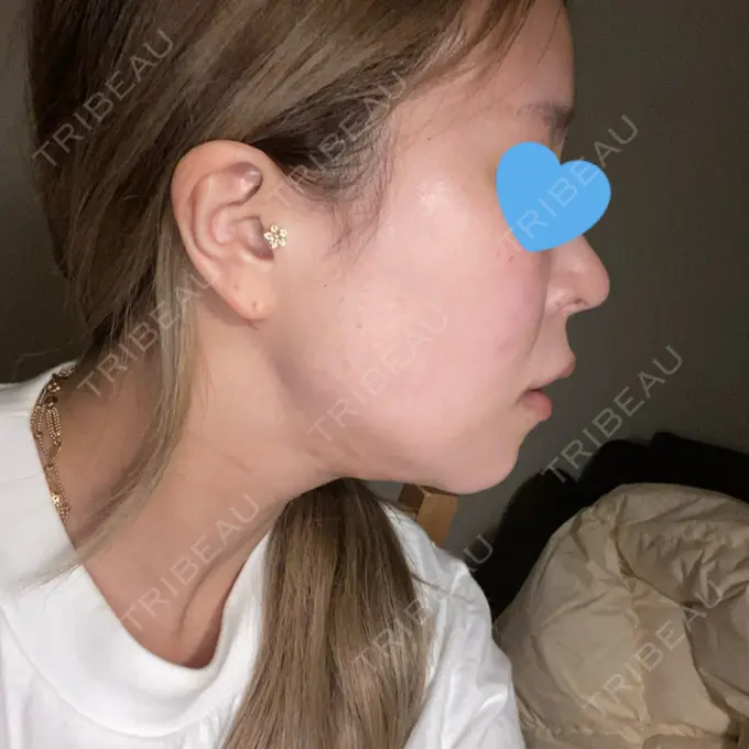 脂肪吸引（顔） Casa de GRACIA GINZA 【カーサデグラシアギンザ】 DAY 34 メイン用