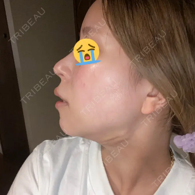 脂肪吸引（顔） Casa de GRACIA GINZA 【カーサデグラシアギンザ】 DAY 34 メイン用