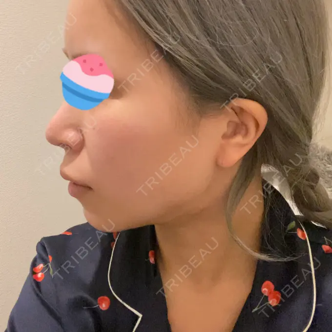 脂肪吸引（顔） Casa de GRACIA GINZA 【カーサデグラシアギンザ】 DAY 46 メイン用