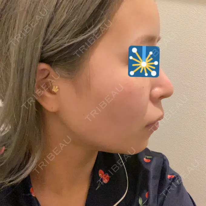 脂肪吸引（顔） Casa de GRACIA GINZA 【カーサデグラシアギンザ】 DAY 46 メイン用