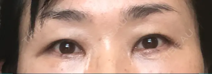 クマ治療 / 下まぶたたるみ取り / 下まぶたの脂肪取り / 目元修正 / その他（目元） 吉井クリニック DAY 19 メイン用