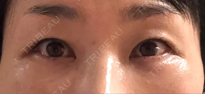 クマ治療 / 下まぶたたるみ取り / 下まぶたの脂肪取り / 目元修正 / その他（目元） 吉井クリニック DAY 23 メイン用