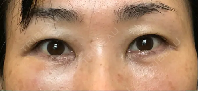 クマ治療 / 下まぶたたるみ取り / 下まぶたの脂肪取り / 目元修正 / その他（目元） 吉井クリニック DAY 25 メイン用