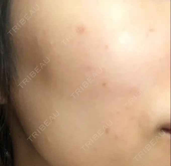 ほくろ・いぼ切除（肌） / 白玉点滴・注射 / プラセンタ注射 / その他（肌） / 美肌レーザー / ほくろ・いぼ除去レーザー（肌） / ニキビ治療 YOU&I皮膚科 明洞店 AFTER メイン用