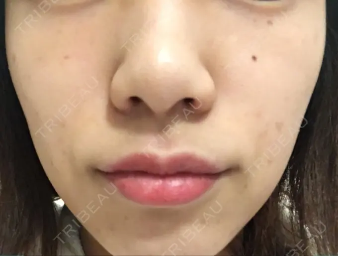 ほくろ・いぼ切除（肌） / 白玉点滴・注射 / プラセンタ注射 / その他（肌） / 美肌レーザー / ほくろ・いぼ除去レーザー（肌） / ニキビ治療 YOU&I皮膚科 明洞店 DAY 15 メイン用