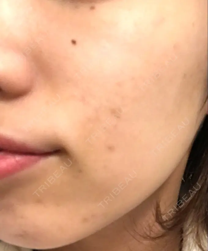 ほくろ・いぼ切除（肌） / 白玉点滴・注射 / プラセンタ注射 / その他（肌） / 美肌レーザー / ほくろ・いぼ除去レーザー（肌） / ニキビ治療 YOU&I皮膚科 明洞店 DAY 15 メイン用