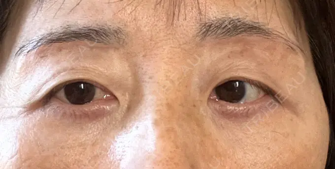 眉下切開 みずほクリニック AFTER メイン用