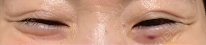 ボトックス（目尻） 湘南美容クリニック 大阪あべの院 DAY 2 メイン用