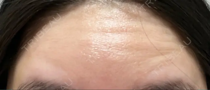 ボトックス（額） 湘南美容クリニック 大阪あべの院 DAY 2 メイン用