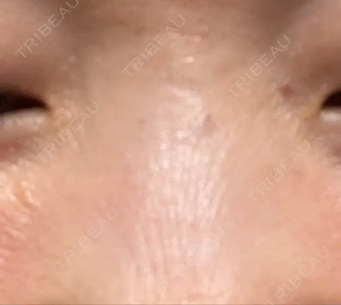 その他（鼻） 湘南美容クリニック 大阪あべの院 DAY 2 メイン用