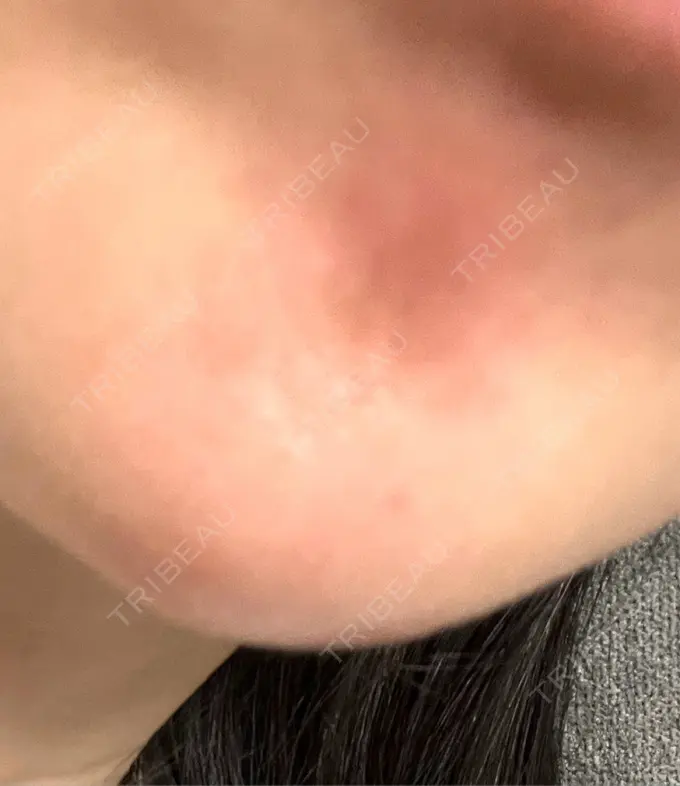 ボトックス（あご） 湘南美容クリニック 大阪あべの院 DAY 2 メイン用