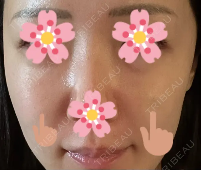 ヒアルロン酸注入（頬） 湘南美容クリニック 宇都宮院 DAY 2 メイン用