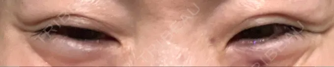 ボトックス（目尻） 湘南美容クリニック 大阪あべの院 DAY 3 メイン用