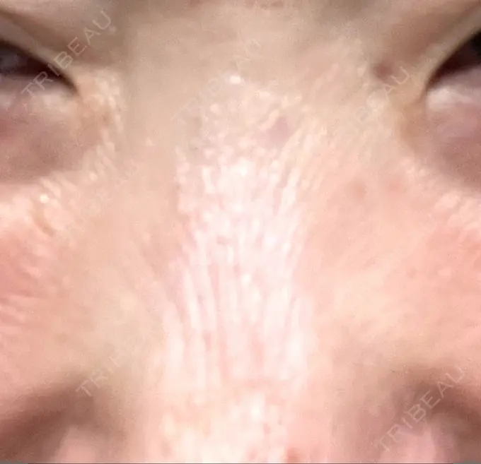 その他（鼻） 湘南美容クリニック 大阪あべの院 DAY 3 メイン用