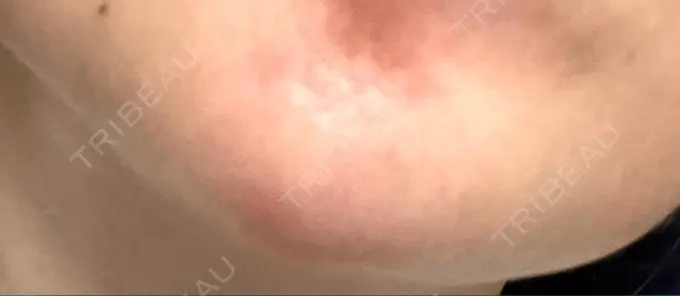 ボトックス（あご） 湘南美容クリニック 大阪あべの院 DAY 3 メイン用