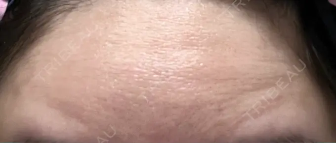 ボトックス（額） 湘南美容クリニック 大阪あべの院 DAY 3 メイン用