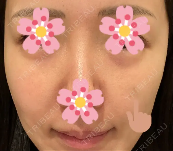 ヒアルロン酸注入（頬） 湘南美容クリニック 宇都宮院 DAY 3 メイン用