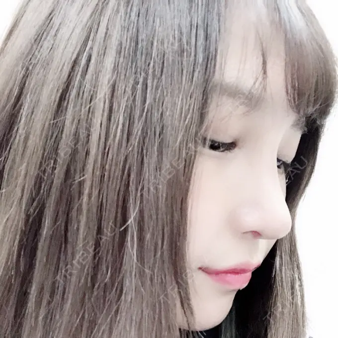 隆鼻術 / 鼻尖形成（切開） / 鼻中隔延長（切開） / 軟骨移植 / その他（鼻） FROM B整形外科 (旧バウム整形外科) DAY 12 メイン用