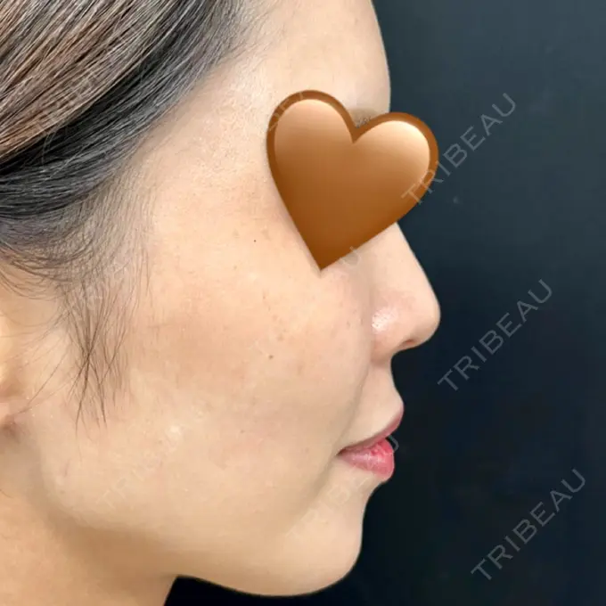 ヒアルロン酸注入（あご） / ボトックス（エラ・小顔） / ヒアルロン酸注入（頬） / ヒアルロン酸注入（こめかみ） / 美容点滴・美容注射（ダイエット） 湘南美容クリニック 京都院 AFTER メイン用