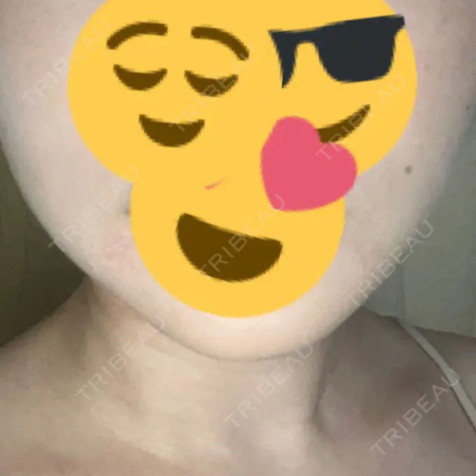 脂肪溶解注射（顔） 表参道ウィズ・クリニック DAY 43 メイン用