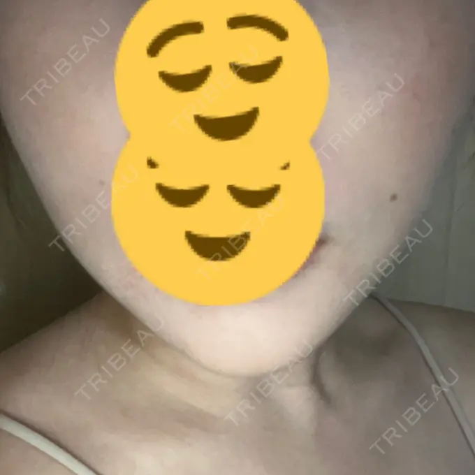 脂肪溶解注射（顔） 表参道ウィズ・クリニック AFTER メイン用