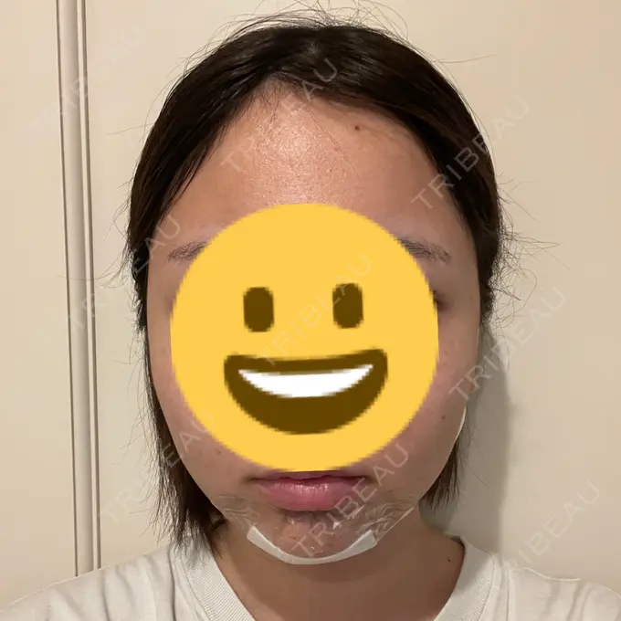 糸リフト / 脂肪吸引（顔） Casa de GRACIA GINZA 【カーサデグラシアギンザ】 DAY 2 メイン用